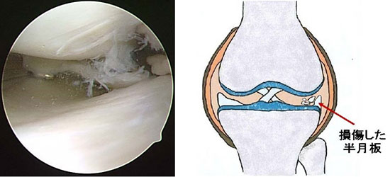 損傷した半月板